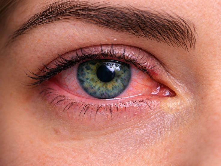 Contact Lens Comfort and Dry Eye